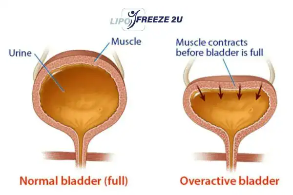 diagram of overactive bladder treatment Rickmansworth