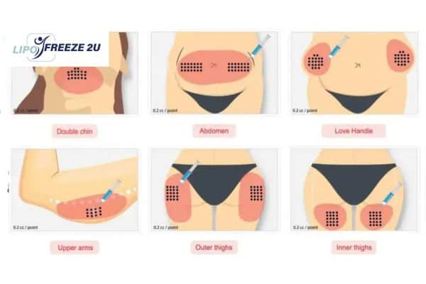 Benefits of Choosing Aqualyx for Fat Reduction Rickmansworth