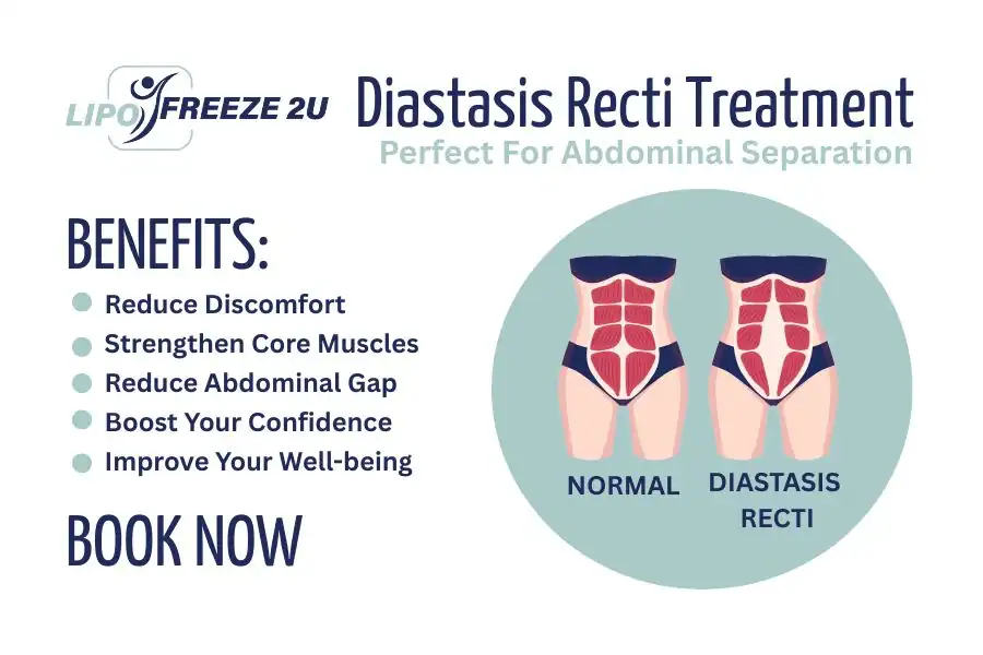 Benefits of body toning treatment Rickmansworth for Diastasis recti