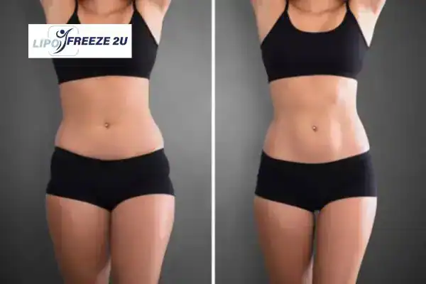 How Can LIPO FREEZE 2U Support Your Post-Pregnancy Body Recovery Rickmansworth?
