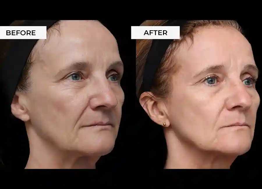 How Many RF Microneedling Sessions Will You Need to See a Difference Rickmansworth?