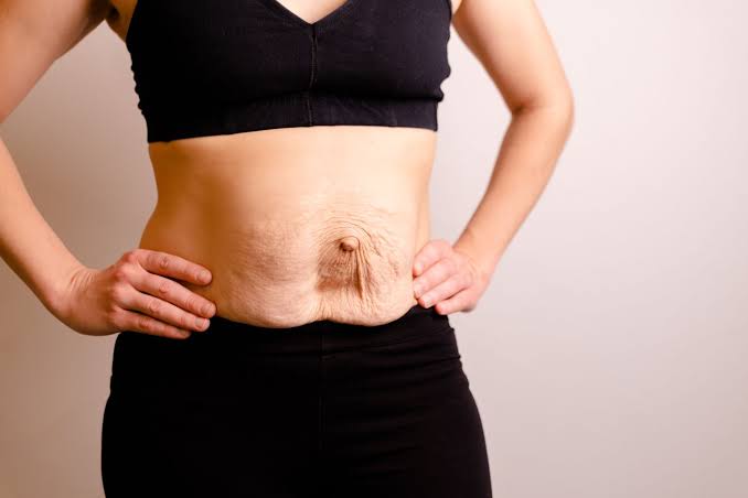 Is Surgery Really the Only Way to Repair Diastasis Recti Rickmansworth?
